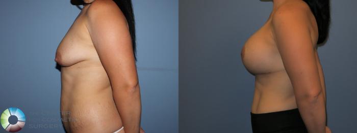 Before & After Breast Lift Case 11515 Left Side View in Golden, CO