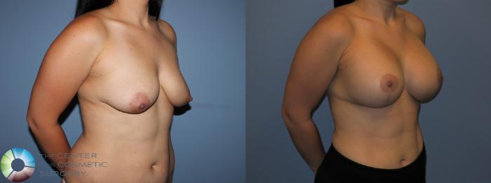 Before & After Breast Lift Case 11515 Right Oblique View in Golden, CO