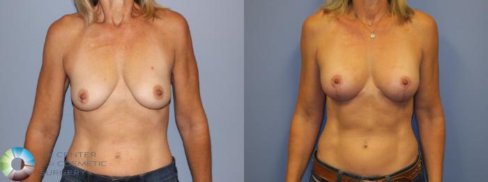 Before & After Breast Lift Case 11517 Front View in Golden, CO
