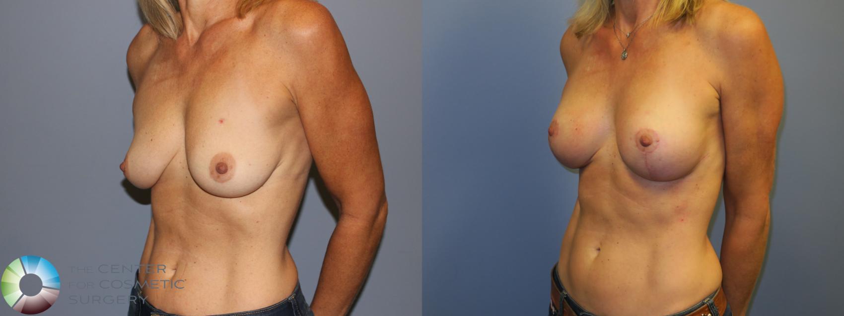 Before & After Breast Lift Case 11517 Left Oblique View in Golden, CO