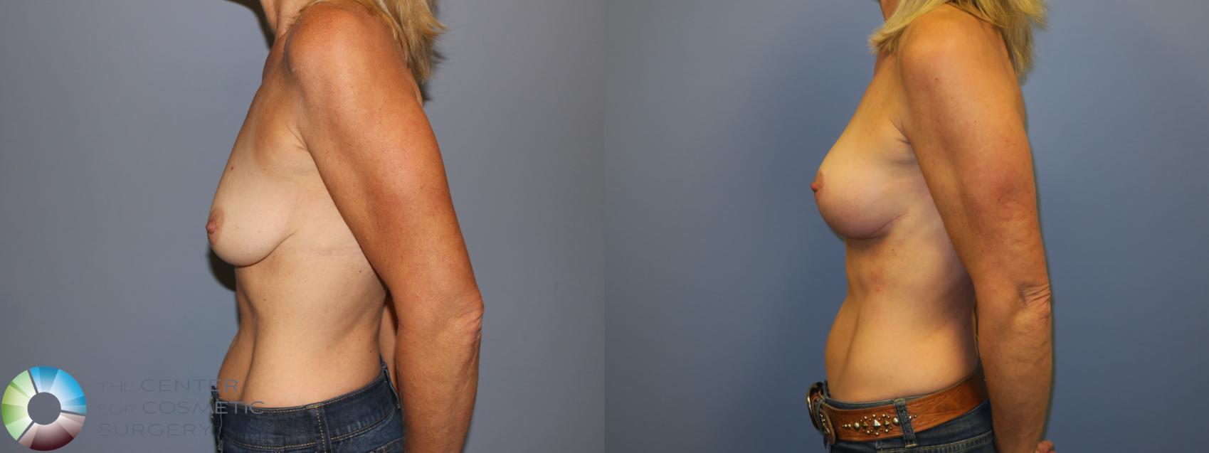 Before & After Breast Lift Case 11517 Left Side View in Golden, CO