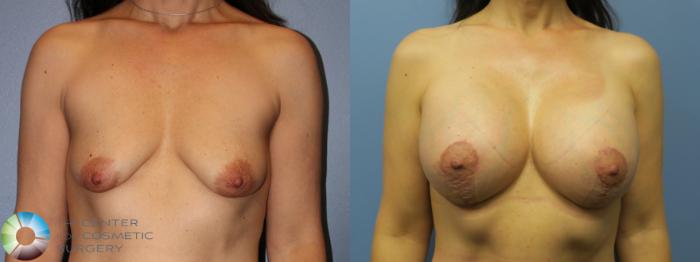 Before & After Breast Lift Case 11608 Front in Denver and Colorado Springs, CO