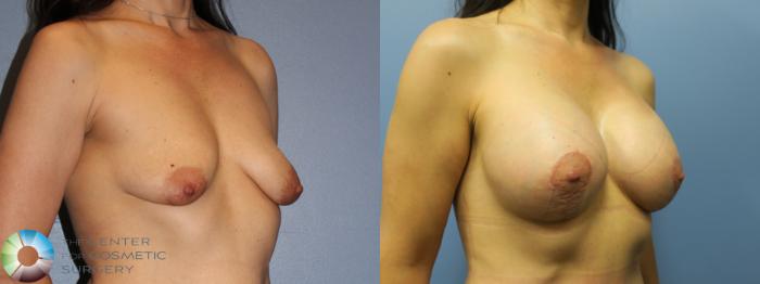Before & After Breast Augmentation Case 11608 Right Oblique in Denver and Colorado Springs, CO