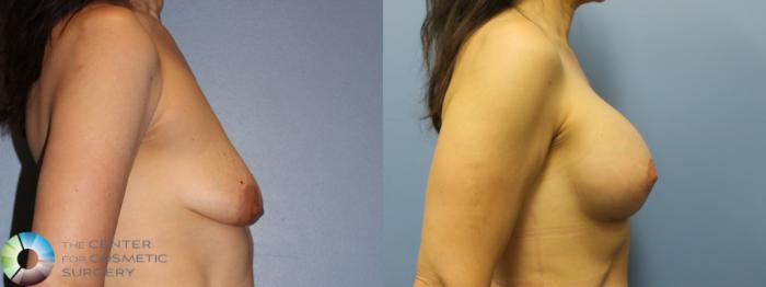 Before & After Breast Lift Case 11608 Right Side in Denver and Colorado Springs, CO
