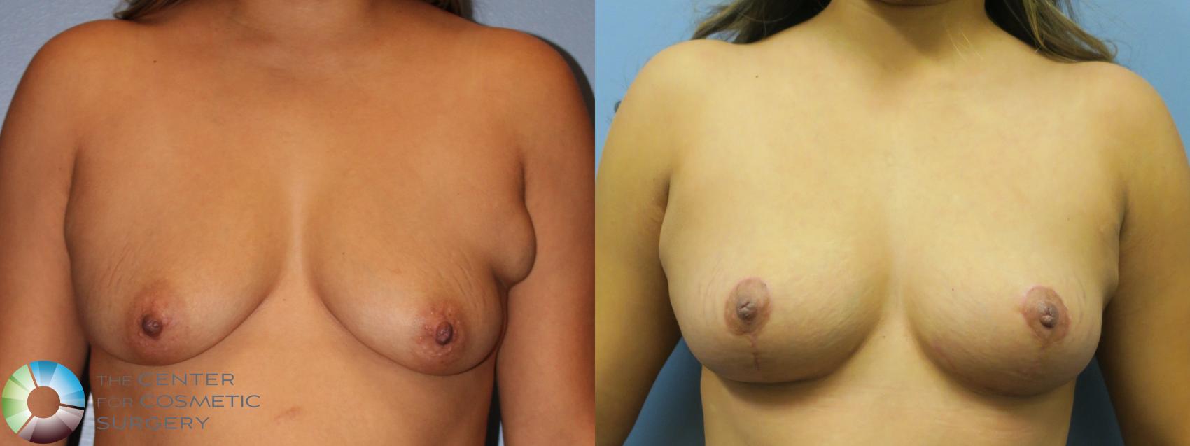 Before & After Breast Lift Case 11630 Front in Denver and Colorado Springs, CO