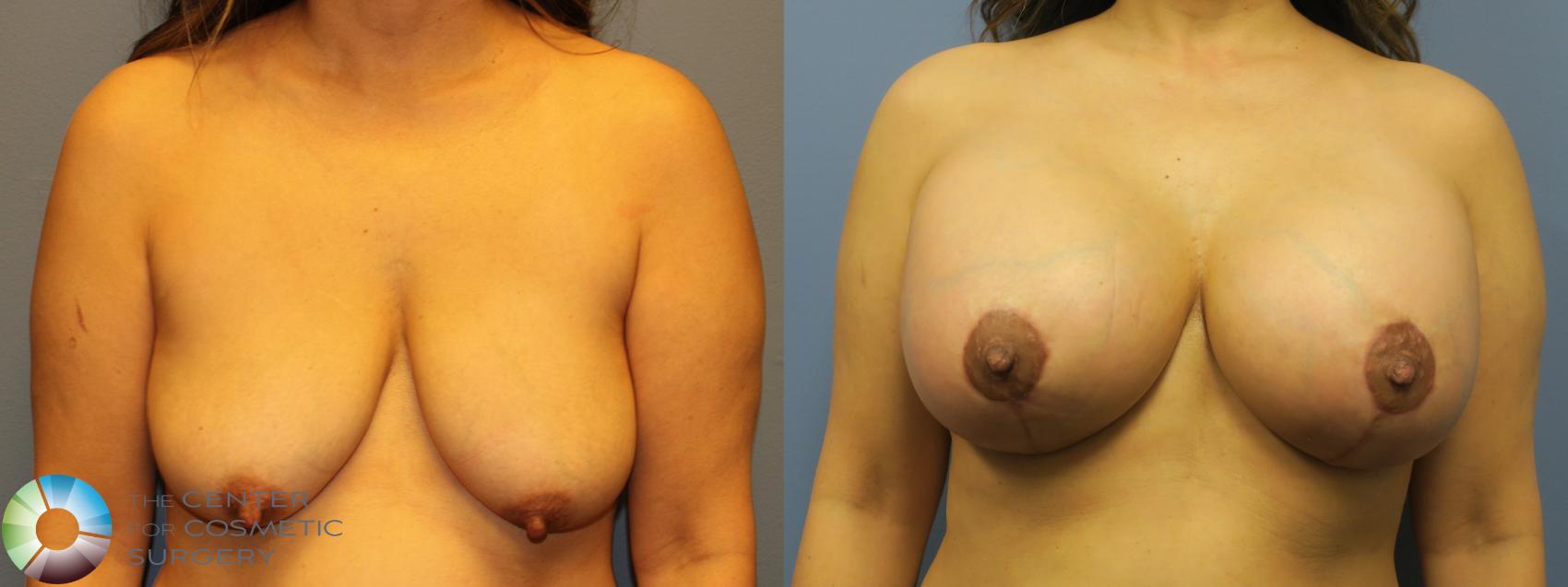 Before & After Breast Augmentation Case 11749 Front in Denver and Colorado Springs, CO