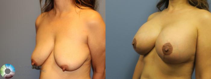 Best Denver Breast Lift Implants