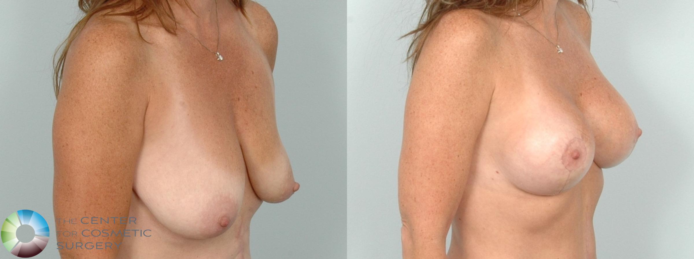 Before & After Breast Augmentation Case 11826 Right Oblique View in Denver & Golden, CO