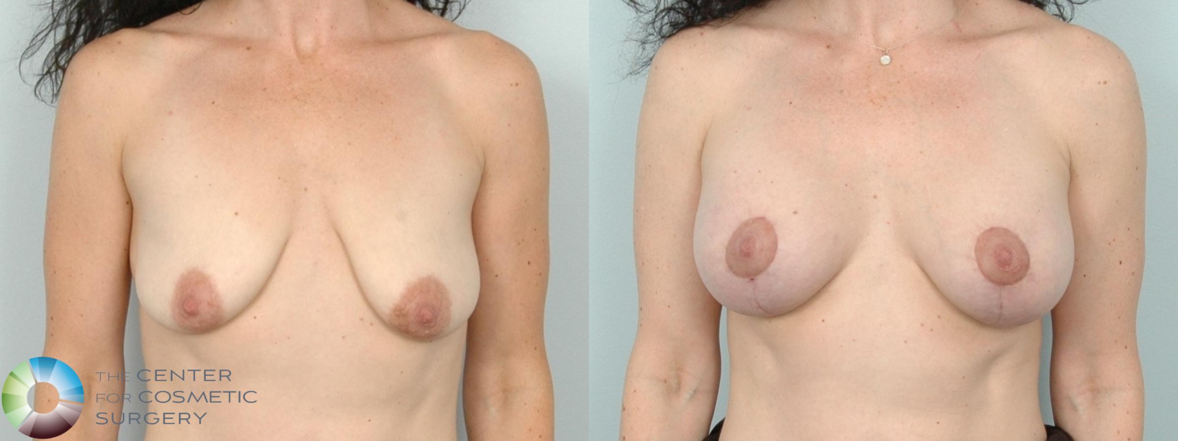 Before & After Breast Lift Case 11827 Front View in Denver & Golden, CO