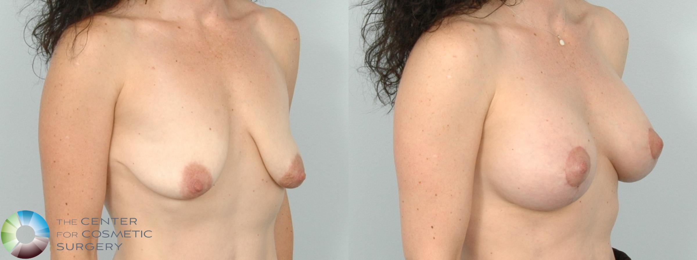 Before & After Breast Lift Case 11827 Right Oblique View in Denver & Golden, CO