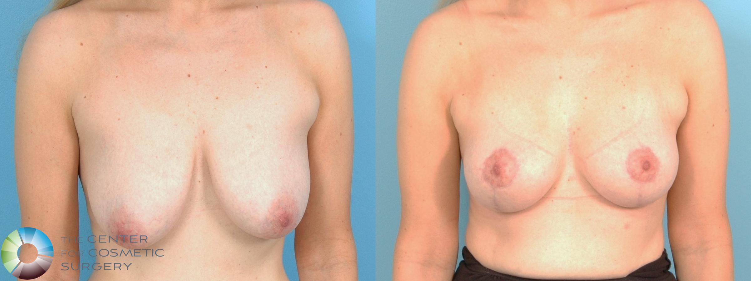 Before & After Breast Lift without Implants Case 11829 Front View in Denver & Golden, CO