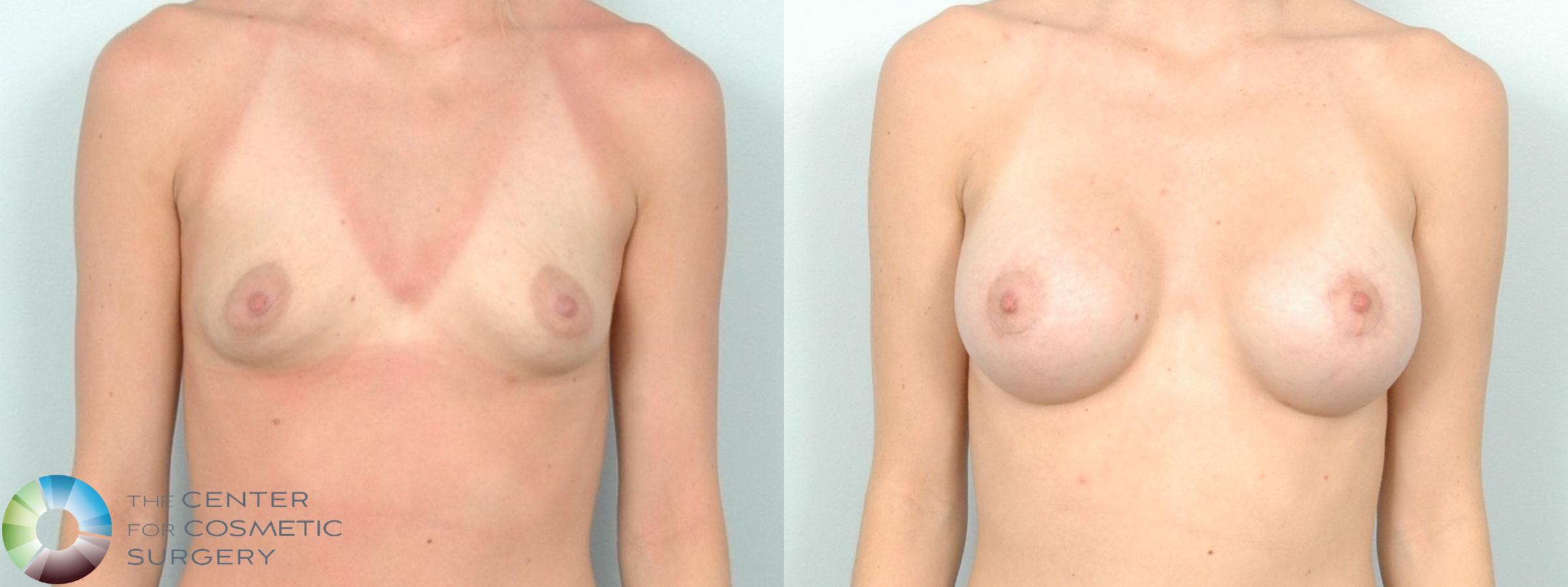 Before & After Breast Lift Case 11835 Front View in Denver & Golden, CO