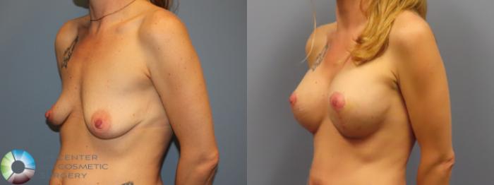 Before & After Breast Augmentation Case 11902 Left Oblique in Denver and Colorado Springs, CO