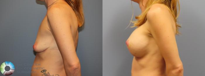 Before & After Breast Augmentation Case 11902 Left Side in Denver and Colorado Springs, CO
