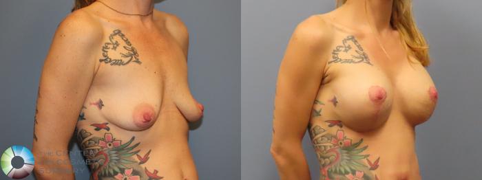 Before & After Breast Lift Case 11902 Right Oblique in Denver and Colorado Springs, CO