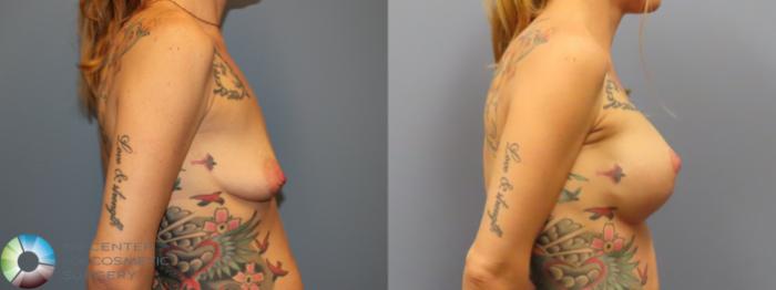 Before & After Breast Lift Case 11902 Right Side in Denver and Colorado Springs, CO