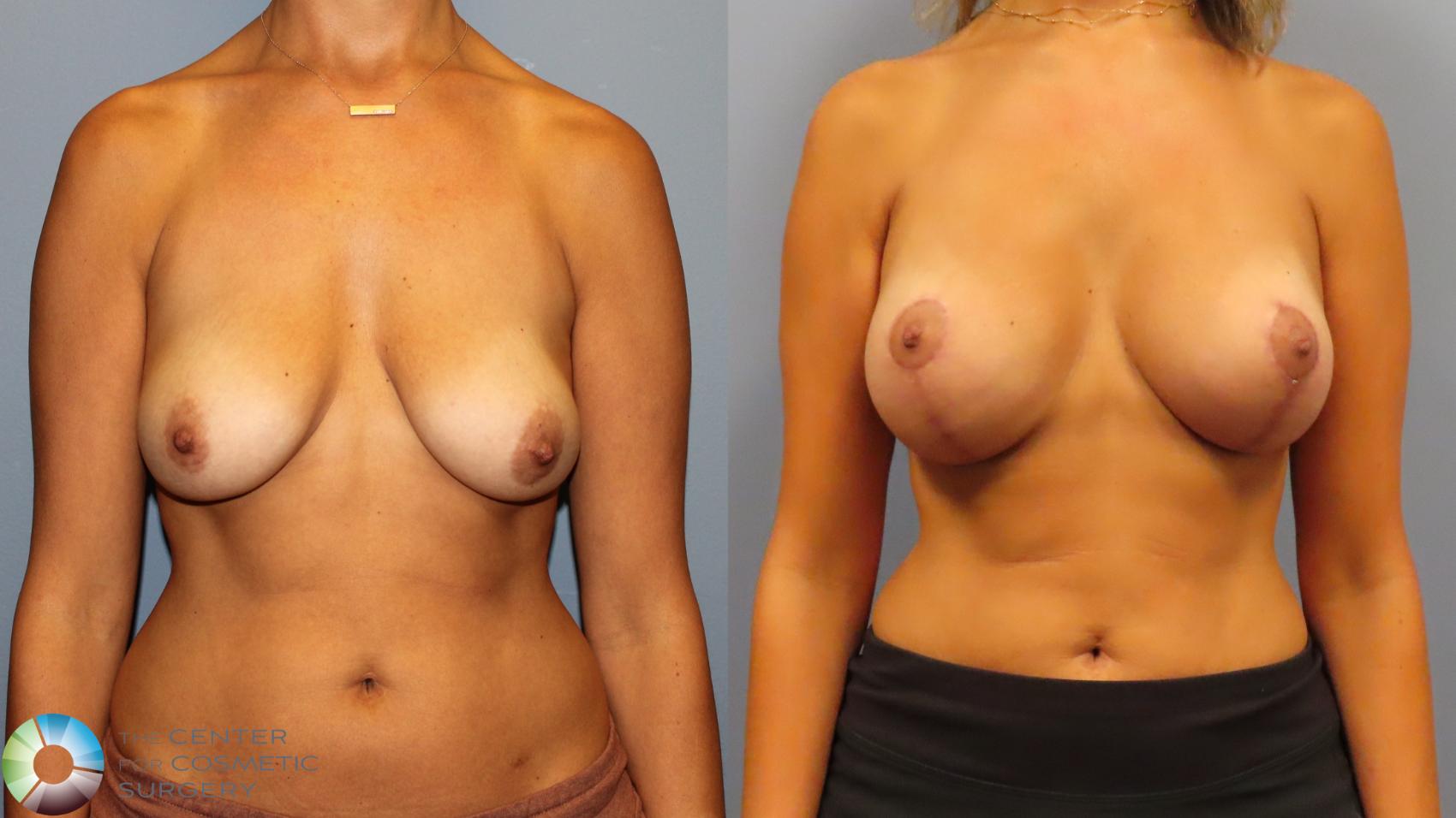 Before & After Breast Augmentation Case 11919 Front in Denver and Colorado Springs, CO