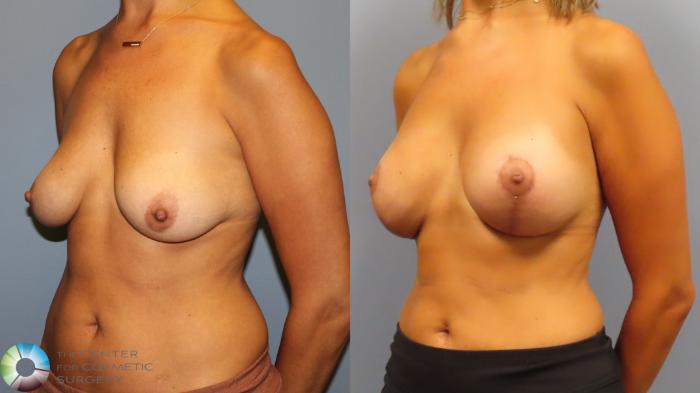 Before & After Breast Augmentation Case 11919 Left Oblique in Denver and Colorado Springs, CO