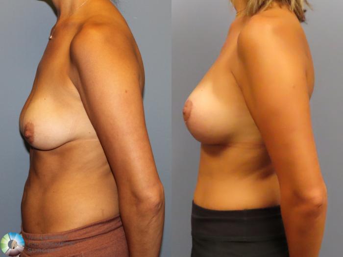 Before & After Breast Lift Case 11919 Left Side in Denver and Colorado Springs, CO