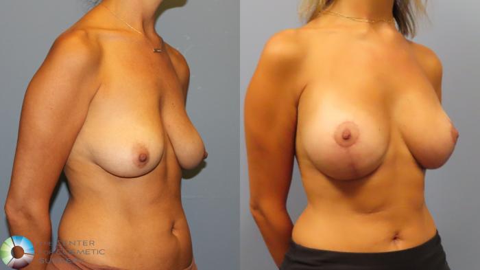 Before & After Breast Lift Case 11919 Right Oblique in Denver and Colorado Springs, CO