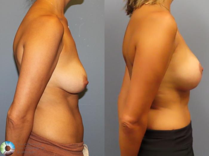 Before & After Breast Augmentation Case 11919 Right Side in Denver and Colorado Springs, CO