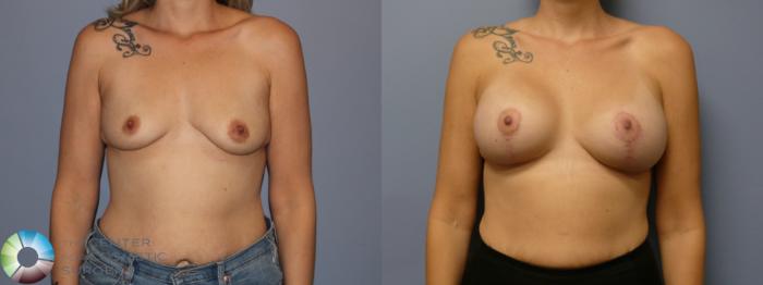 Before & After Breast Lift Case 11941 Front in Denver and Colorado Springs, CO