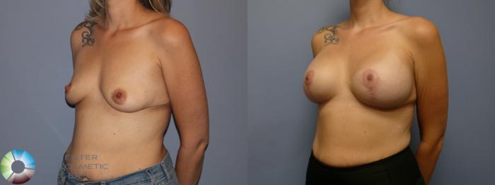 Before & After Breast Lift Case 11941 Left Oblique in Denver and Colorado Springs, CO