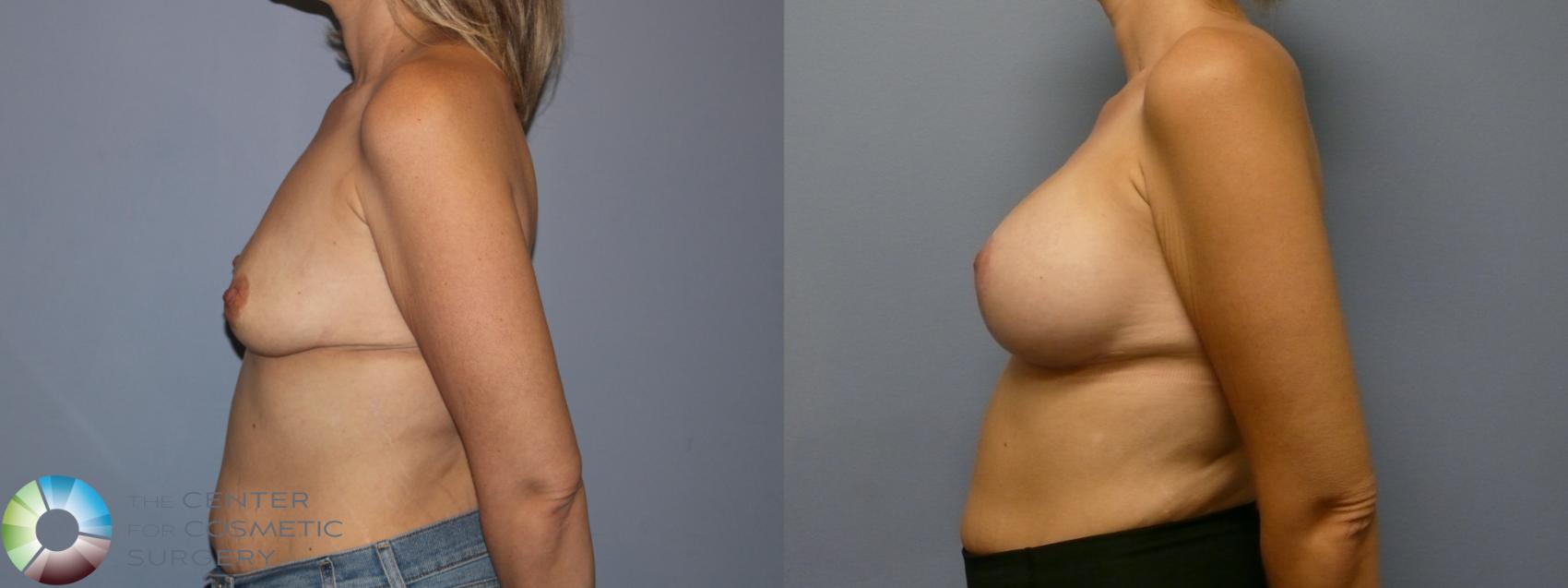 Before & After Breast Lift Case 11941 Left Side in Denver and Colorado Springs, CO