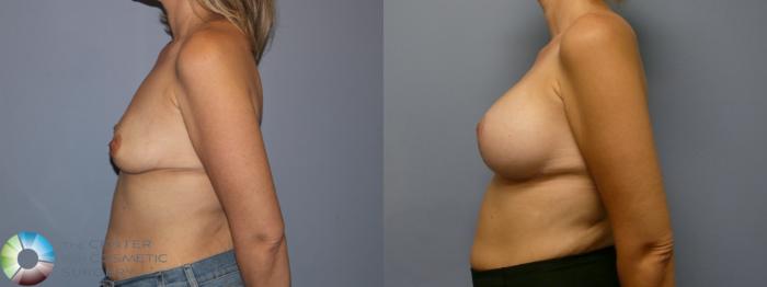 Before & After Breast Augmentation Case 11941 Left Side in Denver and Colorado Springs, CO