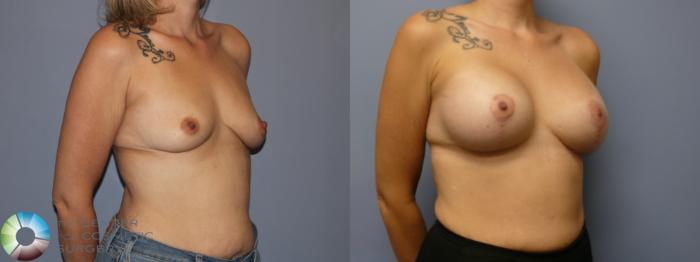 Before & After Breast Lift Case 11941 Right Oblique in Denver and Colorado Springs, CO