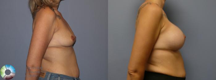Before & After Breast Lift Case 11941 Right Side in Denver and Colorado Springs, CO