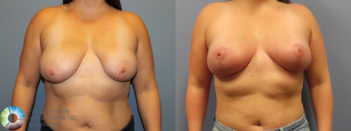 Before & After Breast Lift without Implants Case 11974 Front in Denver and Colorado Springs, CO
