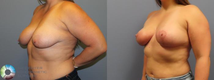 Before & After Breast Lift without Implants Case 11974 Left Oblique in Denver and Colorado Springs, CO