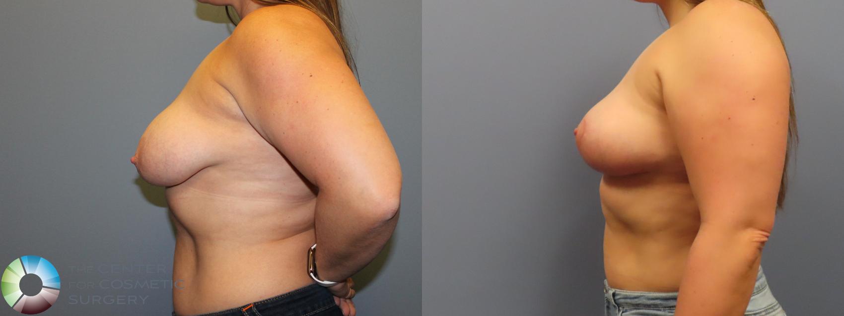 Before & After Breast Lift Case 11974 Left Side in Denver and Colorado Springs, CO