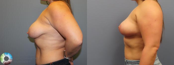 Before & After Breast Lift without Implants Case 11974 Left Side in Denver and Colorado Springs, CO