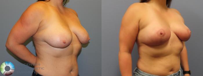 Before & After Breast Lift Case 11974 Right Oblique in Denver and Colorado Springs, CO