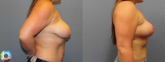 Before & After Breast Lift without Implants Case 11974 Right Side in Denver and Colorado Springs, CO