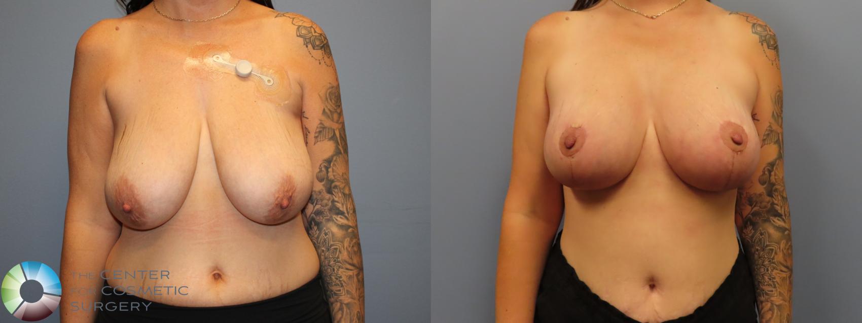 Before & After Breast Lift Case 12023 Front in Denver and Colorado Springs, CO