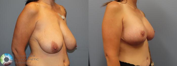 Before & After Breast Lift Case 12023 Right Oblique in Denver and Colorado Springs, CO