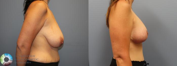 Before & After Breast Augmentation Case 12023 Right Side in Denver and Colorado Springs, CO