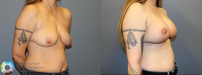 Before & After Breast Lift Case 12029 Right Oblique in Denver and Colorado Springs, CO