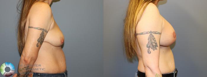 Before & After Breast Lift Case 12029 Right Side in Denver and Colorado Springs, CO