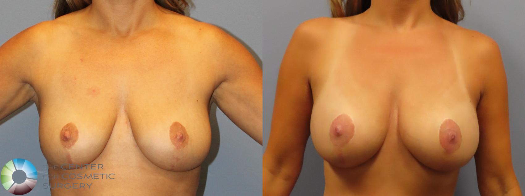 Best Denver Breast Implants Augmentation/Lift