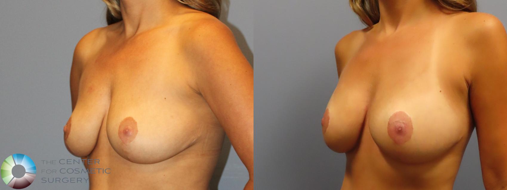 Before & After Breast Lift Case 12050 Left Oblique in Denver and Colorado Springs, CO