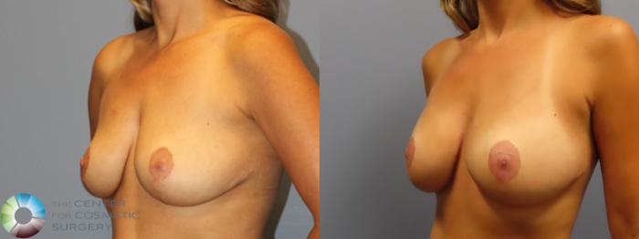 Best Denver Breast Implants Augmentation/Lift