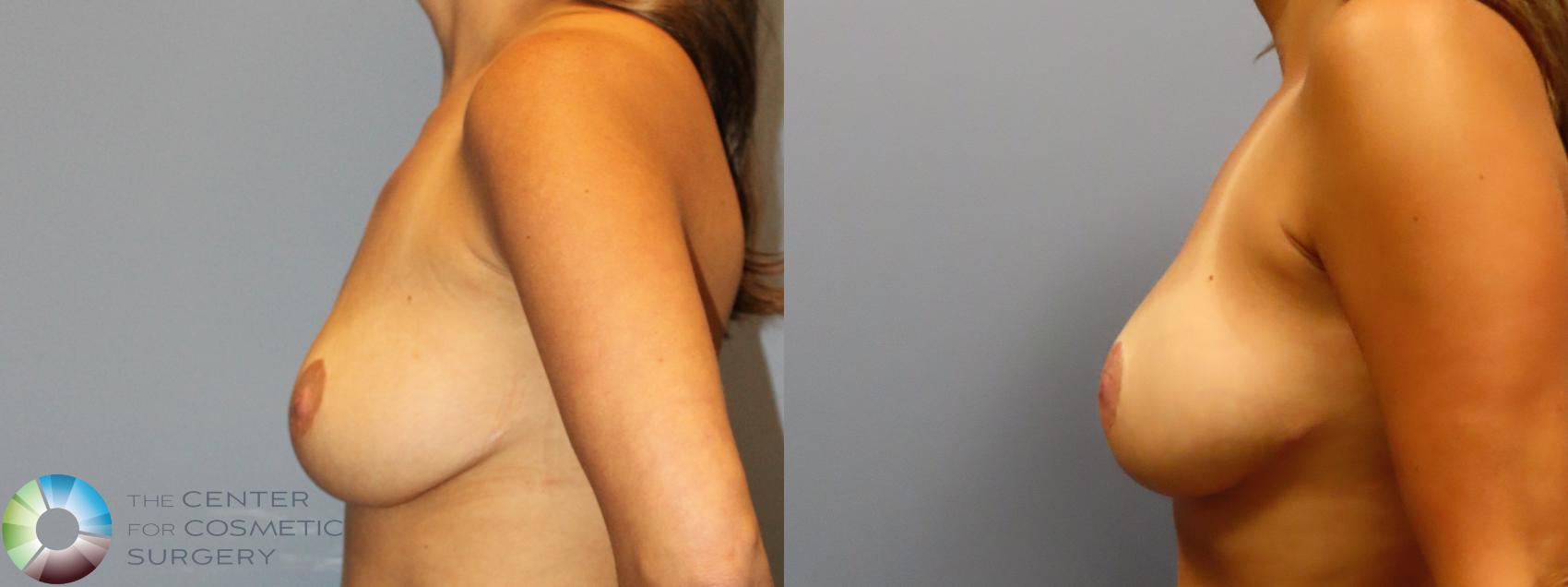 Before & After Breast Lift Case 12050 Left Side in Denver and Colorado Springs, CO