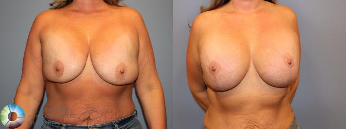 Before & After Breast Implant Revision Case 12064 Front in Denver and Colorado Springs, CO