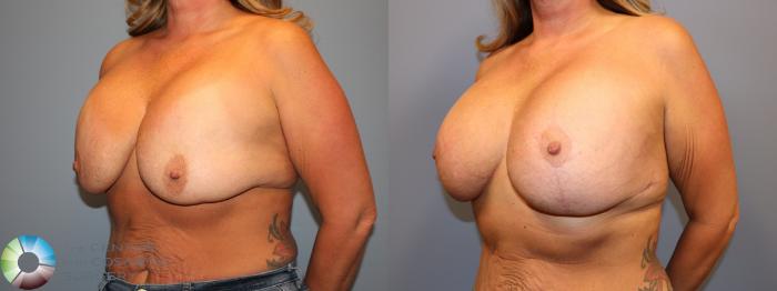 Before & After Breast Implant Revision Case 12064 Left Oblique in Denver and Colorado Springs, CO