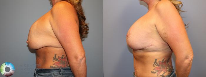 Before & After Breast Lift Case 12064 Left Side in Denver and Colorado Springs, CO