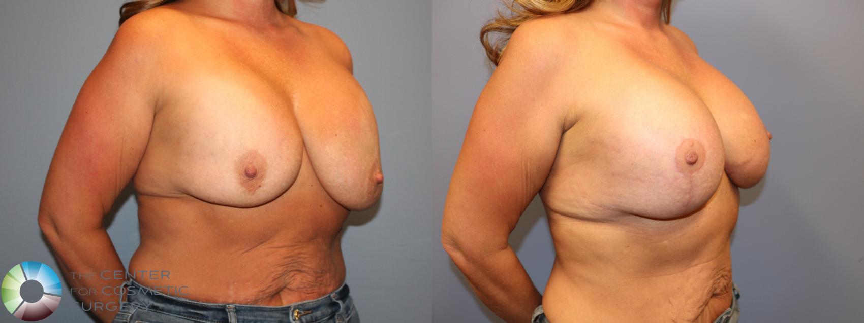 Before & After Breast Implant Revision Case 12064 Right Oblique in Denver and Colorado Springs, CO